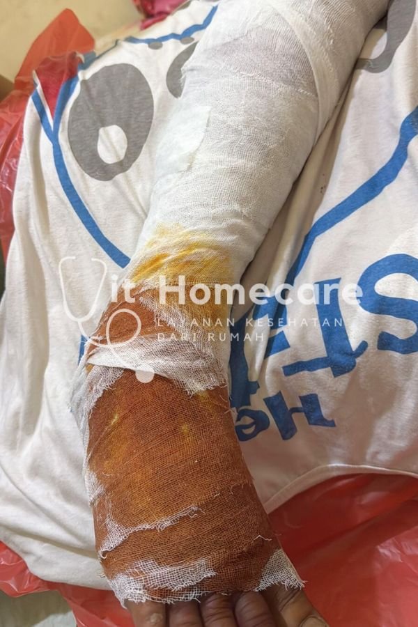 perawatan luka homecare